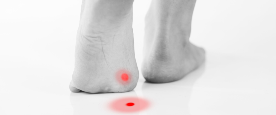 Diabetes and Feet – Plantar Warts